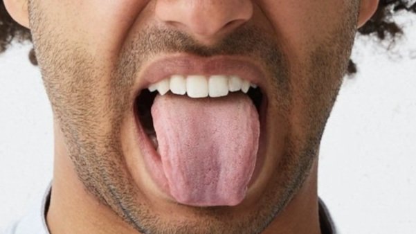 Man with tongue out to look for signs of cancer