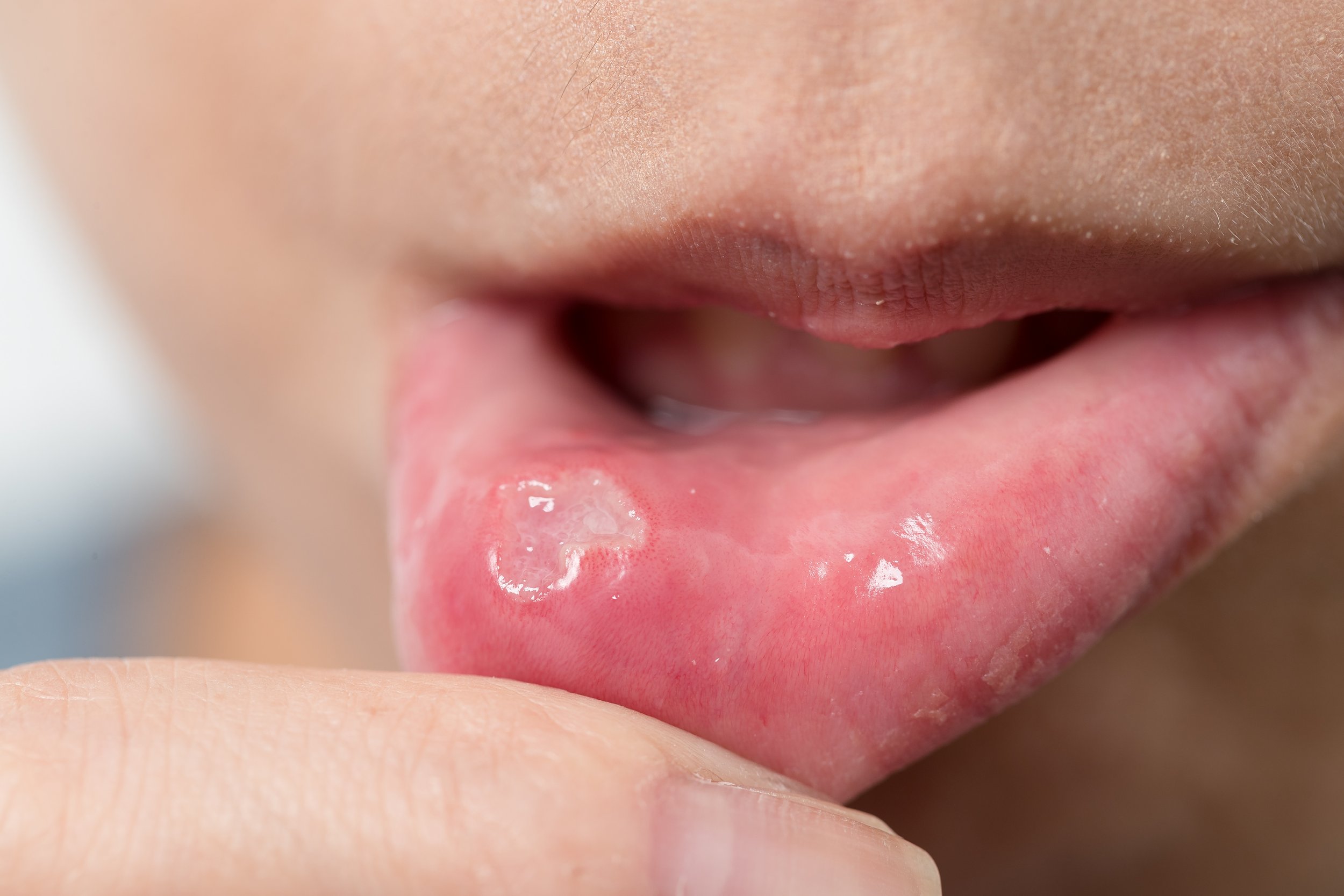 Man with an ulcer in the mouth, potentially indicating cancer