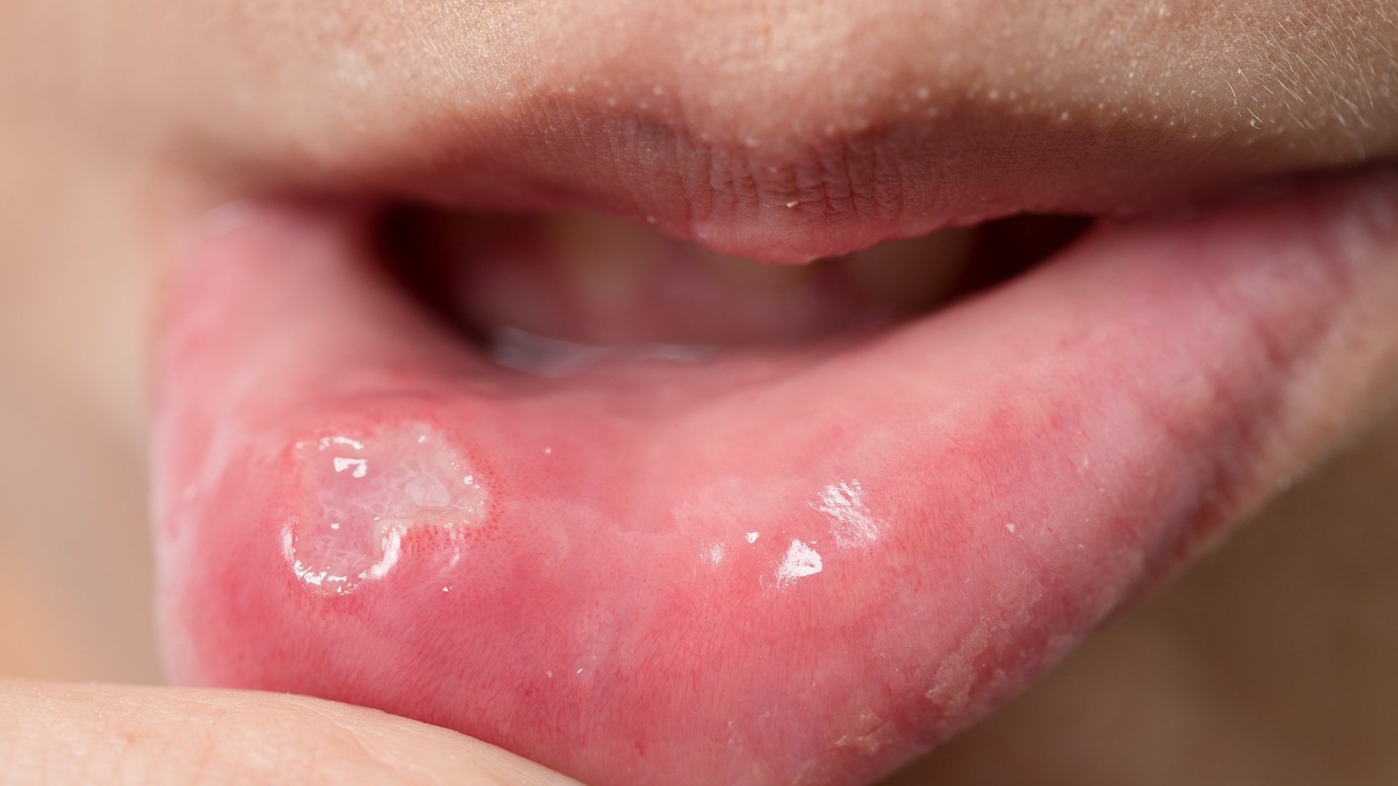Ulcer found on tongue after looking for signs of cancer